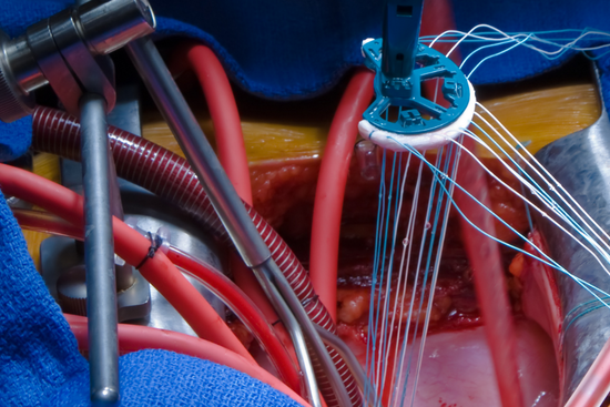 Kalp Kapakları Ve Cerrahisi (2)