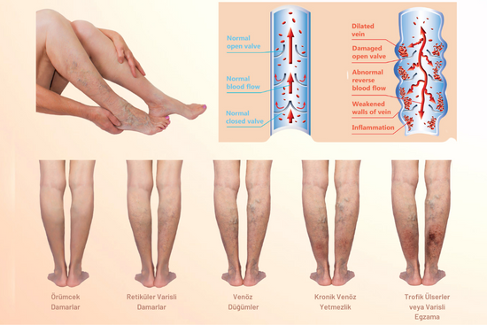 Varis Ve Tedavisi (2)
